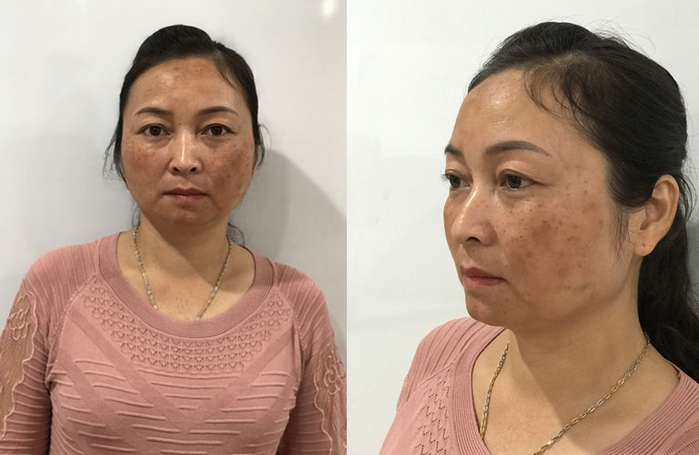 Tình trạng nám, tàn nhang của cô Tạ Thị Vân, 47 tuổi