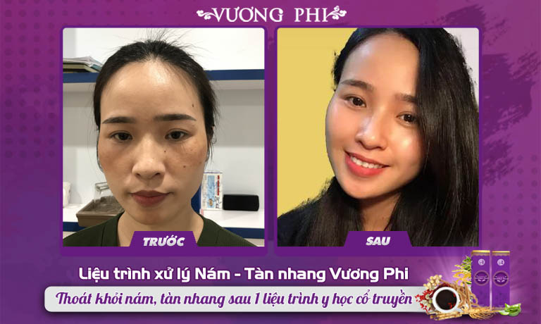 Chị Thanh Thảo (28 tuổi, Hà Nội) cảm thấy may mắn khi đã thoát khỏi nám nhờ Vương Phi
