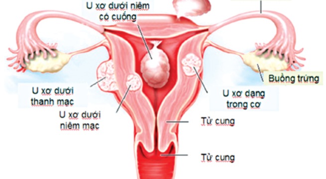 u-xo-tu-cung-la-benh-phu-khoa-thuong-gap1