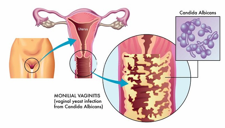 Nấm âm đạo là bệnh phụ khoa phổ biến ở nữ giới