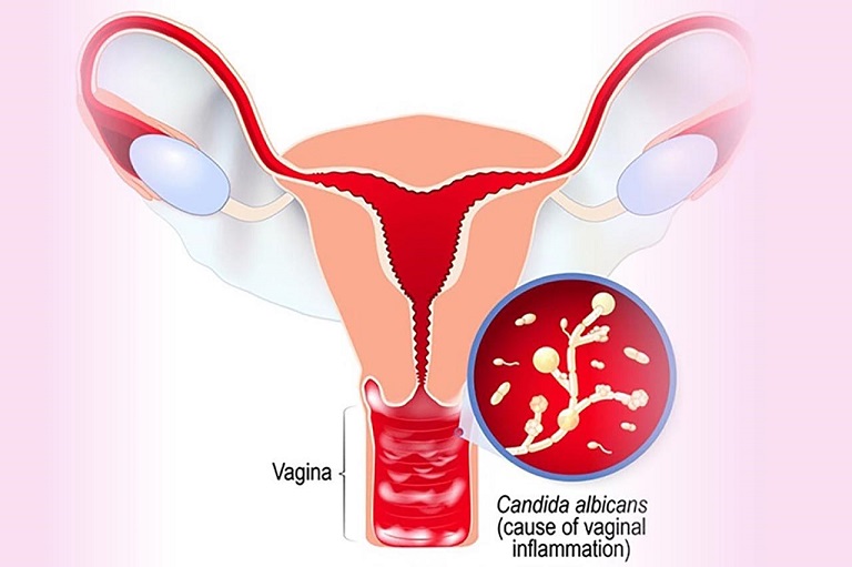 Viêm nấm âm đạo cần được điều trị kịp thời để tránh biến chứng